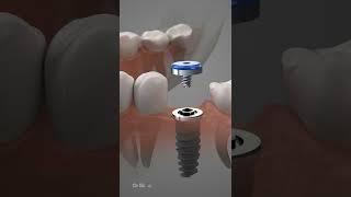 Dental Implant Procedure