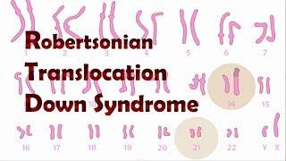 Robertsonian Translocation Down Syndrome ROB