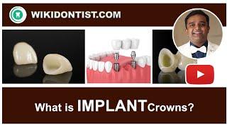 Implant Crowns Dental Videos  Dr. Thomas Nechupadam