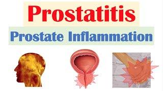 Prostatitis Prostate Inflammation Different Types Causes Signs & Symptoms Diagnosis Treatment