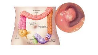 Mayo Clinic Minute Symptoms of colon cancer