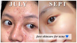 Rekomendasi Skincare utk Jerawat kombinasi berminyak