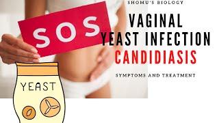 Vaginal yeast infection treatment causes and prevention