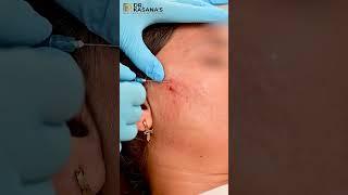 Subcision for Acne Scars  Acne Scar Treatment  Cheek Acne Scar Removal  Dr Pooja Kasana