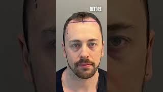 Hair Transplant Before and After of Matthew 6 MONTHS  5000 Grafts