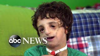 Boy living with Treacher Collins has 53 surgeries by age 11 2020 Part 2