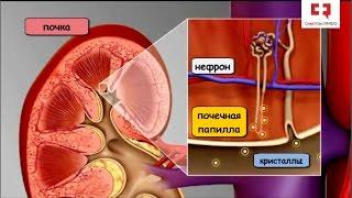 Камни в почках виды камней этапы формирования факторы риска мочекаменной болезни и профилактика