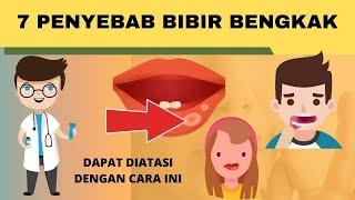 Bibir Tiba-Tiba Bengkak? Ketahui Penyebabnya Ini