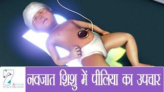 नवजात शिशु में पीलिया का उपचार  Treatment for Jaundice in the Newborn  Hindi