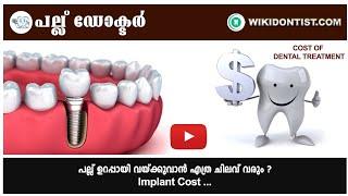 പല്ല് ഉറപ്പായി വയ്ക്കുവാൻ എത്ര ചിലവ് വരും Implant CostPart - 2Video by Dr.Thomas Nechupadam