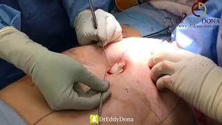 Operasi Pengencangan Perut AbdominoplastyTummy Tuck