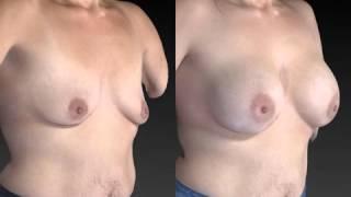 Breast Enhancement 3D Before and After-58