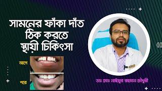 সামনের ফাঁকা দাঁত ঠিক করতে স্থায়ী চিকিৎসা কী?