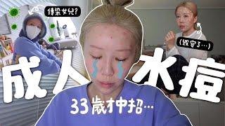 VLOG 毁容了⋯33歲才第一次長水痘? 超過200粒水痘癢到瘋掉? 超痛苦成人水痘一週真實記錄  Lizzy Daily