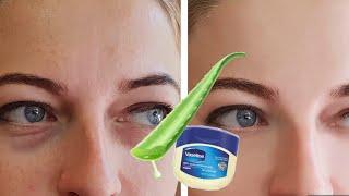 Remove under eyes dark circles puffiness and eye bags in just 3 days#darkcirclescream home remedy