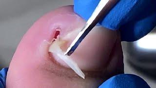 Pedicure Tutorial Very deep ingrown nails causing red swollen and painful toes【Xue Yidao】