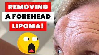 REMOVING A FOREHEAD LIPOMA