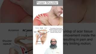 Frozen Shoulder  Adhesive Capsulitis  Shahbaz Qamar