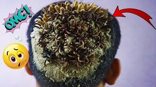 OMG Lots of Tiny Worms On Dandruff Removal #1151