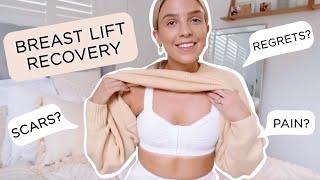 Breast Lift Recovery Scars? Pains? Any Regrets? Internal Bra?  Answering all Your Questions