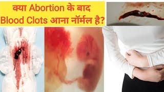 Bleeding After Abortion  क्या Abortion के बाद Blood Clots आना नॉर्मल है  @Narijivan