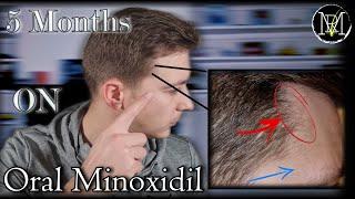 Oral Minoxidil Loniten Results in 5 Months