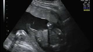 Its a Girl  Ultrasound