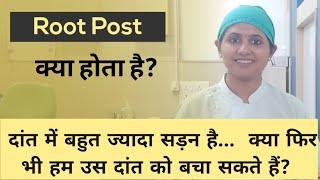 What is Root post? l दांत मे बहुत ज्यादा सडन है फिर भी क्या हम उस दांत को बचा सकते है?