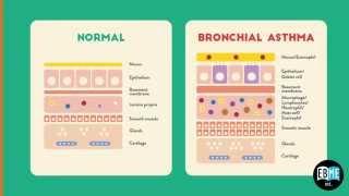 Allergic Asthma Lecture 4