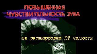 Повысилась ЧУВСТВИТЕЛЬНОСТЬ ЗУБА после пломбирования на РАСШИФРОВКЕ КТ верхней челюсти