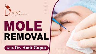 Mole Removal Surgery  Divine Cosmetic Surgery
