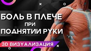 БОЛЬ В ПЛЕЧЕ ПРИ ПОДНЯТИИ РУКИ? АЛГОРИТМ ЛЕЧЕНИЯ