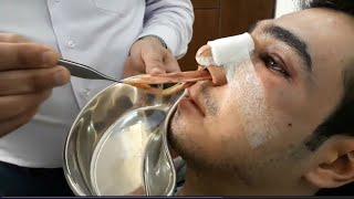 Removing nose mesh 2 days after rhinoplasty surgery   خارج کردن مش بینی 2 روز بعد از عمل جراحی