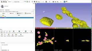 3D Slicer thresholding and segmentation