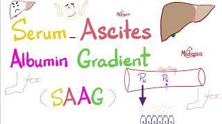 Serum Ascites Albumin Gradient SAAG  Peritoneal Effusion  Lab 