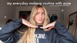 my everyday makeup routine with acne while on accutane