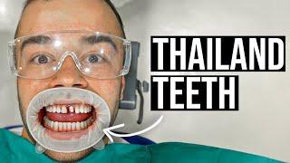 I Got Veneers in Thailand