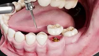 From Start to Finish Understanding the Dental Implant Process