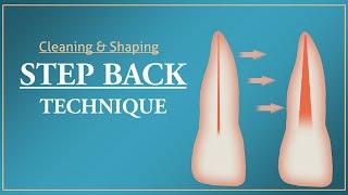 Step Back Technique  Root Canal Treatment