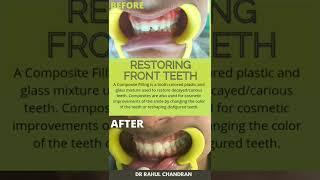 Restoring Broken Front Tooth  Dr Rahul Chandran  Dr Anagha Cheleri  Composite Filling