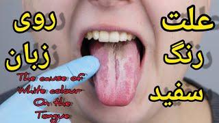 علت رنگ سفید روی زبانthe cause of the white color on the tongue