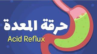 GERD Acid Reflux ارتجاع المريء - الأعراض والعلاج