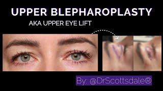 UPPER EYELID SURGERY AKA BLEPHAROPLASTY by @DrScottsdale