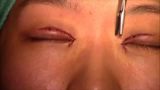 Operasi Lipatan Mata atau double eyelid Blepharoplasty with Epicanthoplasty