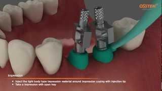 TSIII Fixture Placement & Impression taking Pick-up and Transfer Impression Copings