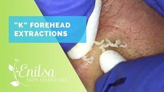 K Forehead Extractions Part I