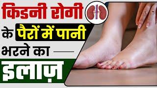 किडनी रोगी के पैरों में सूजन का रामबाण इलाज़  Leg Swelling Treatment in Hindi