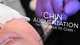 Chin Augmentation with Fat Transfer Explained by Dr. Kian Karimi