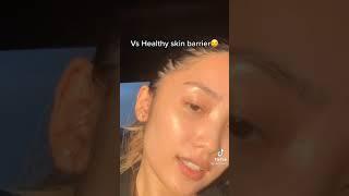 FROM ACNE TO CLEAR SKIN JOURNEY SKINCARE TIKTOK #SHORTS