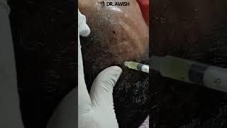 Secrets of PRP Treatment for Hair Growth  Awish Clinic  #viral #haircare #shortsfeed #shorts